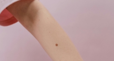 Misteri Tahi Lalat: Bintik Kulit yang Dikaitkan dengan Serangga dan Nasib