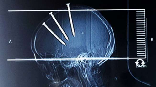 Tiga Paku Tertancap di Kepala Lelaki Cina