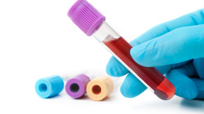 Ilustrasi tes darah. (Sumber: Shutterstock)