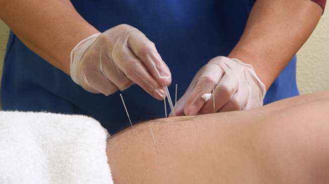 Metode pengobatan dengan akupunktur. (Foto: shutterstock)