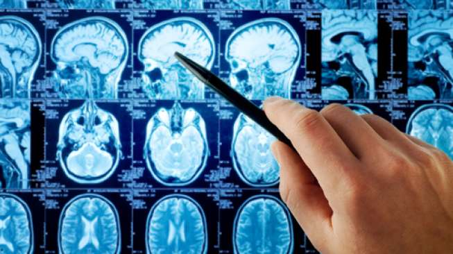 Peneliti Melakukan Uji Coba Pengobatan Kanker Otak Mematikan Menggunakan Virus