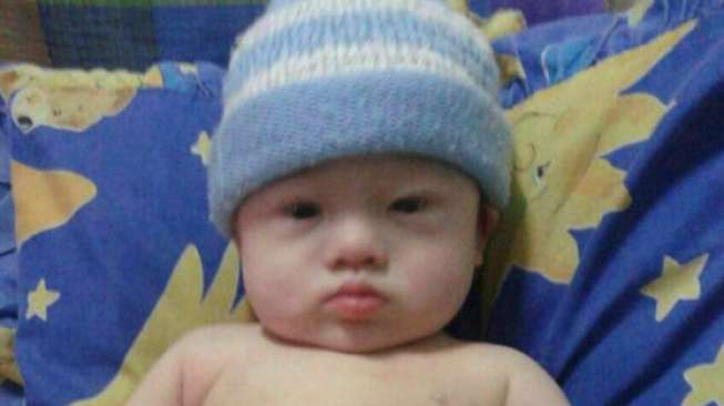 Derita "Down Syndrome", Bayi Mungil Ditelantarkan Orangtua