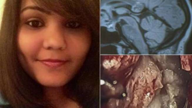 Disangka Tumor, Ternyata Ada 'Kembaran' di Otak Perempuan Ini