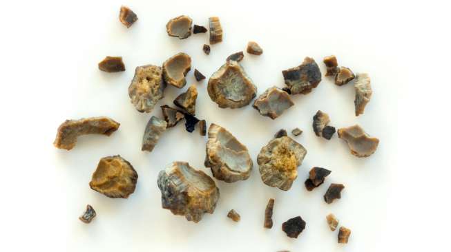 Batu ginjal bisa terbentuk jika sering menahan kencing. (Shutterstock)