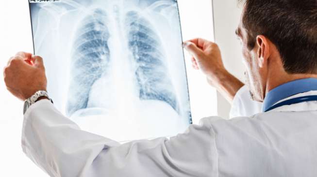Ilustrasi paru-paru, flek paru-paru (shutterstock)