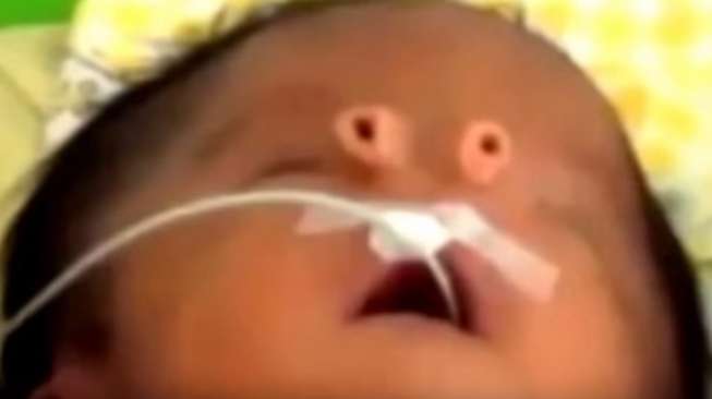 Malaikat Kecil, Nama Buat Bayi yang Lahir dengan Hidung Unik Ini