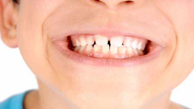Punya Kebiasaan Menggertakkan Gigi saat Tidur? Hati-Hati Komplikasi!