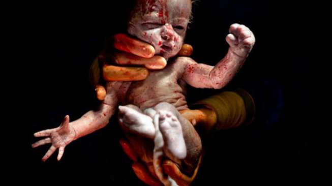 11 Foto Mencengangkan di Dunia Medis Sepanjang 2015