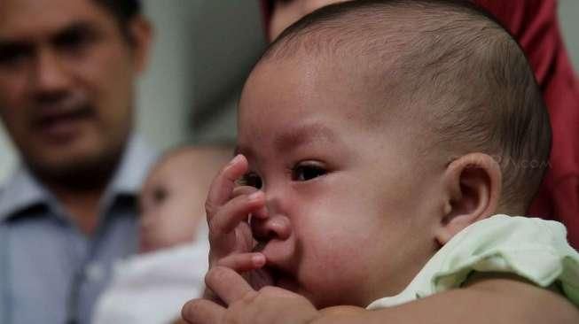 Pemisahan Bayi Kembar Siam Dempet Dada Libatkan 70 Dokter