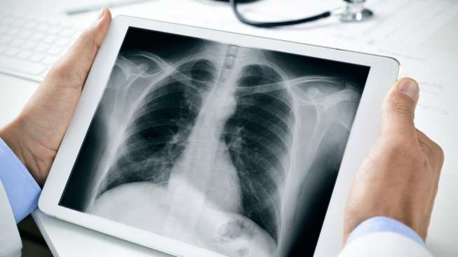Ilustrasi asbes bersarang di paru-paru. [Shutterstock]