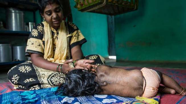 Tumbuh Rambut di Sekujur Tubuh, Bayi Ini Disebut Manusia Serigala