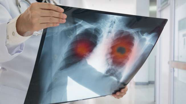 Ilustrasi kanker paru, salah satu penyakit tidak menular. (Shutterstock)