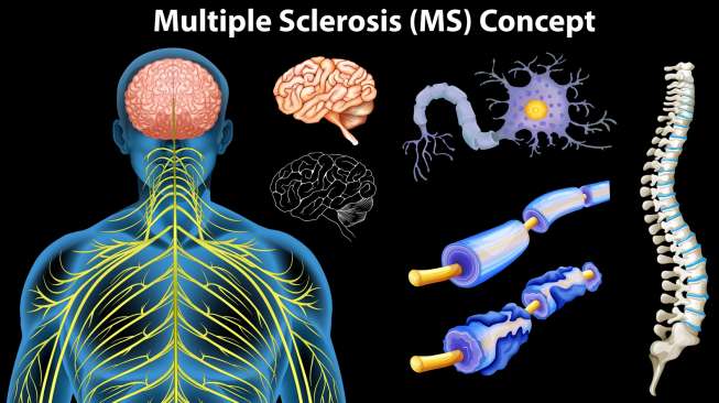 Studi AS Sebut Orang yang Pernah Terinfeksi Virus Herpes Epstein Barr Berisiko Idap Autoimun Multiple Sclerosis