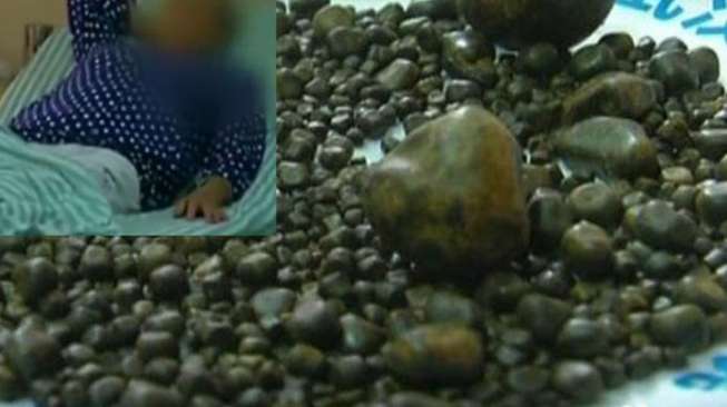 Mengerikan! Ada 800 Batu Empedu Bersarang di Tubuh Nenek Ini