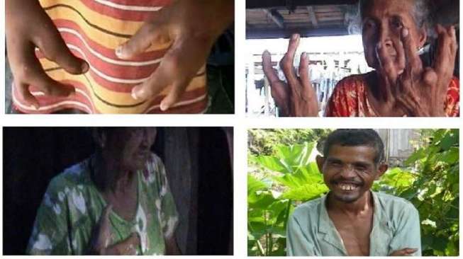 Misteri Kampung "Manusia Kepiting" di Bone Sulsel