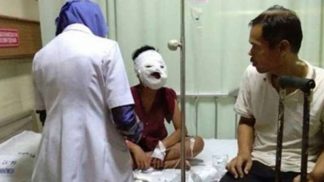 Wajah Bocah yang Diceburkan ke Wajan Tak Bisa Pulih 100 Persen