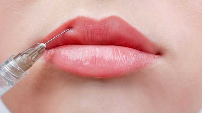 Ilustrasi lip filler atau suntik bibir. [Shutterstock]