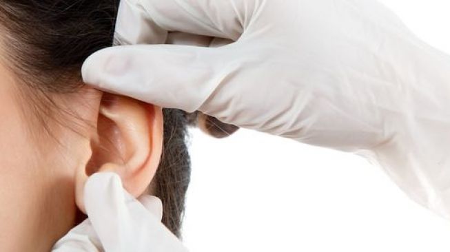 Ilustrasi operasi plastik daun telinga. (Shutterstock)