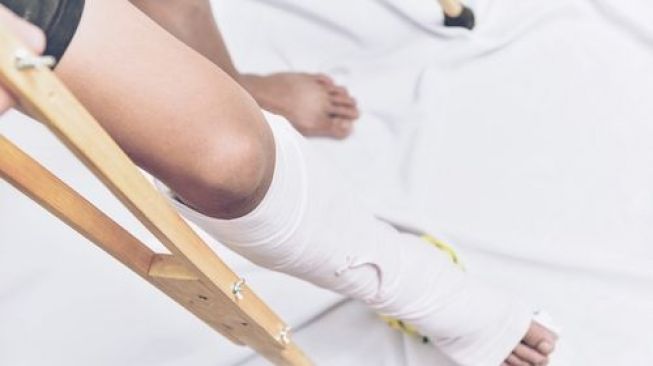Tulang kaki patah bisa ditangani dengan pemasangan pen. (Shutterstock)
