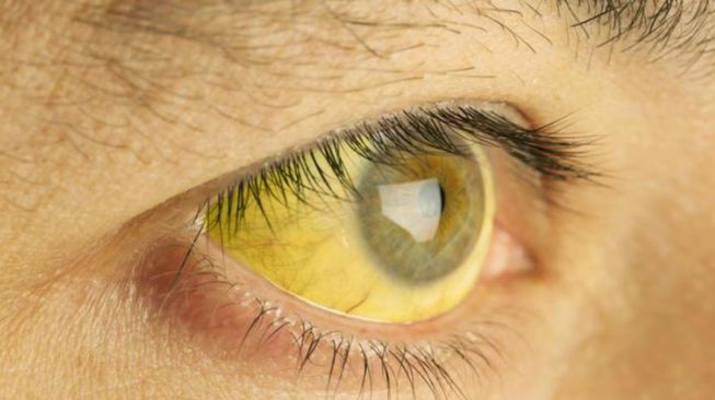 Mata kuning, salah satu gejala Hepatitis B. 
