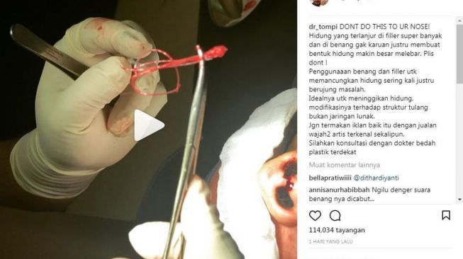 Tompi mengunggah video tentang operasi tanam benang pada hidung. (Instagram)