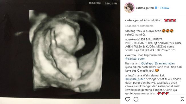 Hasil USG anak kedua aktris Carissa Puteri, Rabu (11/04/2018) [carissa_puteri/instagram]