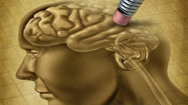 Ilustrasi penyakit demensia (foto: Shutterstock)