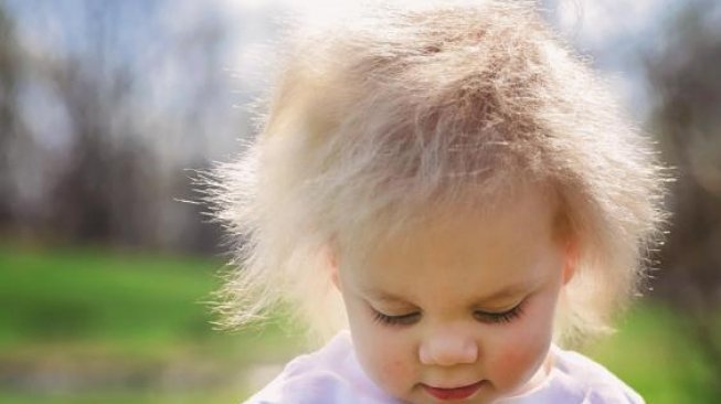 Anak Penderita Sindrom Langka Uncombable Hair Syndrome. (SWNS)