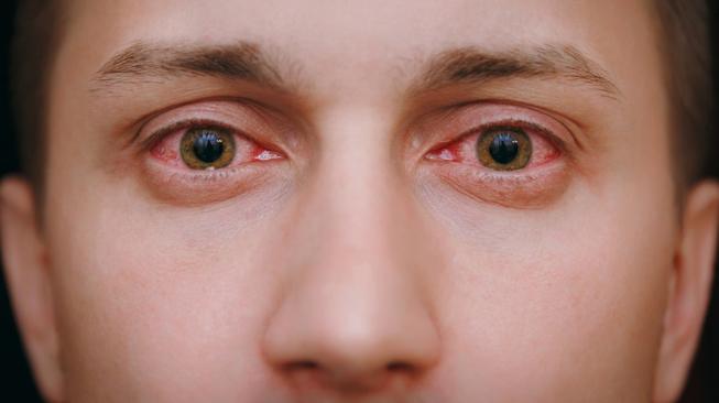 infeksi mata merah (ilustrasi/shutterstock)