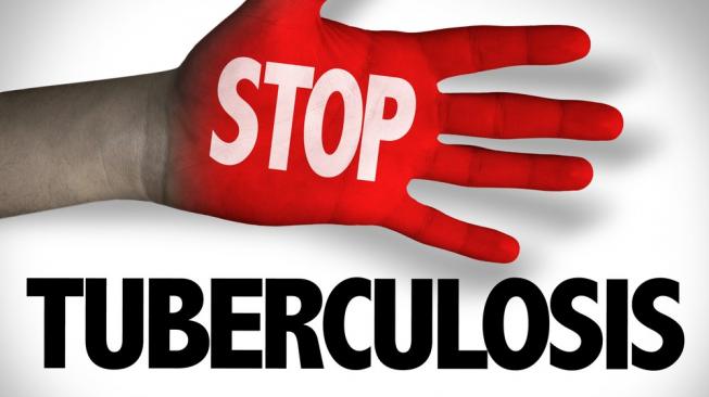 Tuberkulosis (TBC) masih jadi beban di Indonesia. (Shutterstock)