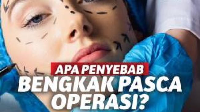 Wajah Ratna Sarumpaet Bengkak Pasca Operasi Plastik. Kenapa......