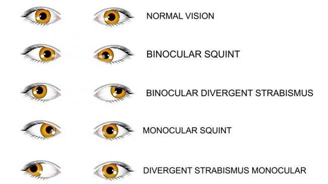 Mata Juling Ini Gejala Penyebab Dan Cara Mengatasinya 6089