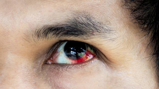 Ilustrasi mata lelaki berdarah [shutterstock]