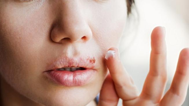 Ilustrasi perbedaan gejala sariawan dan herpes di mulut. (Shutterstock)
