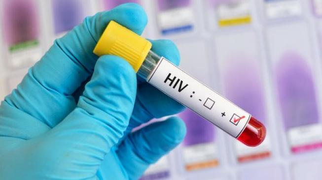 Ilustrasi virus HIV. (Shutterstock)