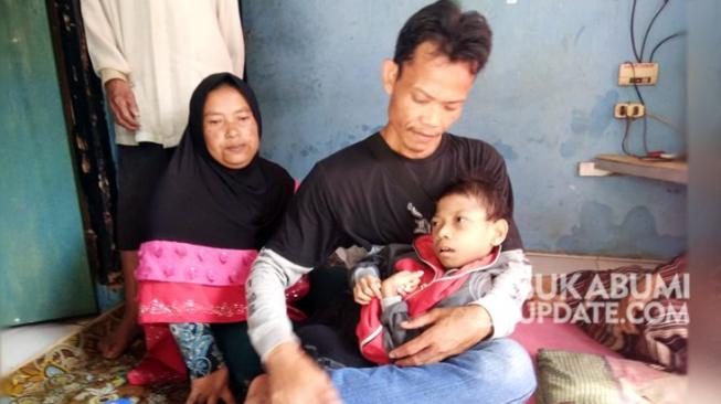 Abidin, bocah difabel asal Sukabumi, mengalami tulang menonjol hingga menembus pahanya. (Sukabumiupdate.com/RAWIN SOEDARYANTO)