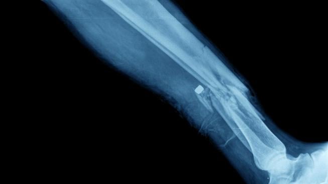 Foto X-ray patah tulang kaki. (Shutterstock)