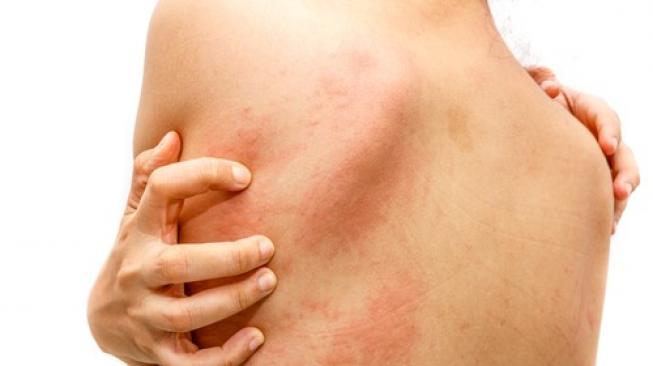 Bintik merah dan bernanah penyakit apa? (Shutterstock) 