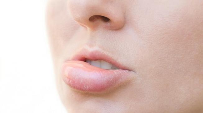 Bibir bengkak merupakan salah satu gejala urtikaria idiopatik kronis. (Shutterstock)