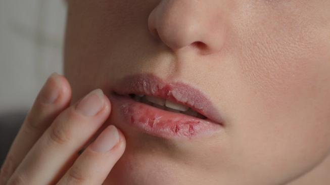 5 Cara Rumahan Mengatasi Bibir Kering atau Bibir Pecah-pecah
