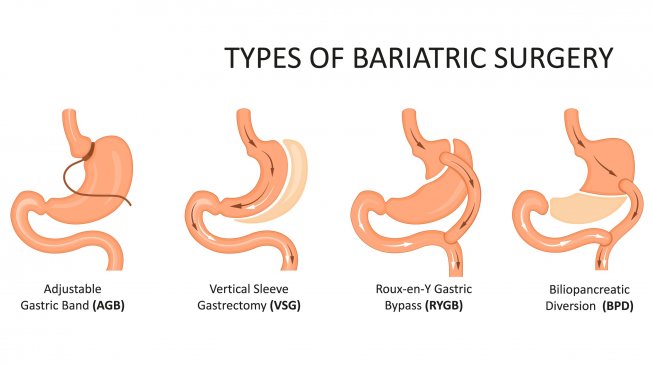 Operasi bariatrik mengubah lambung untuk pasien obesitas ekstrem. (Shutterstock)