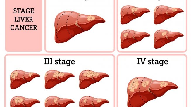 Tahapan kanker hati. (Shutterstock)
