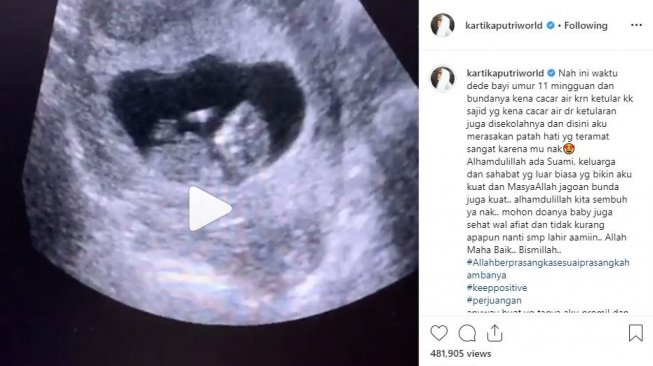 Kartika Putri cerita masa-masa awal kehamilannya. [instagram/kartikaputriworld]