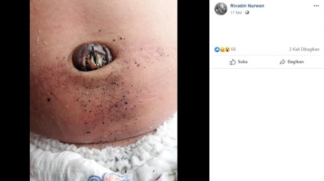 Kondisi bayi kedua yang tali pusarnya diberi tumbukan jahe bakar (Facebook/Rivandi Nurwan)