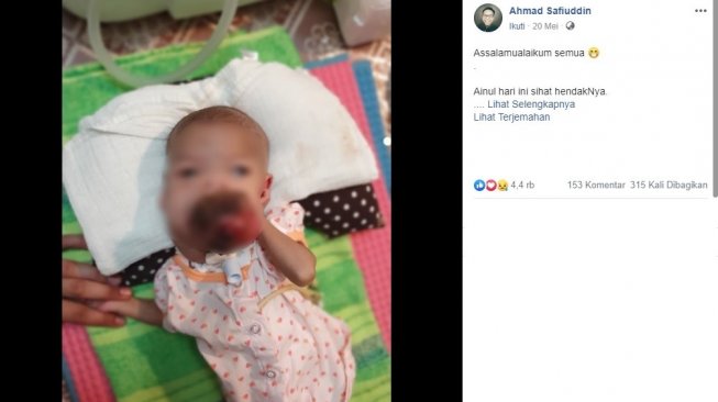 Penyebab bayi 9 bulan ini mengidap tumor mulut (Facebook/Ahmad Safiuddin)