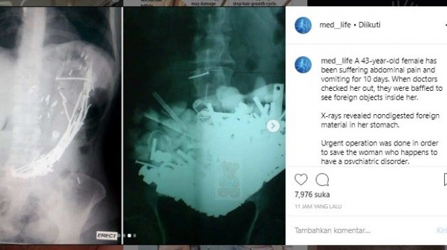 Hasil X-ray dari wanita menderita bezoar (Instagram/Med_life)