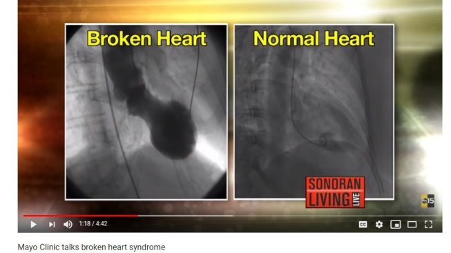 Kondisi jantung orang yang alami patah hati (YouTube/ABC15 Arizona)
