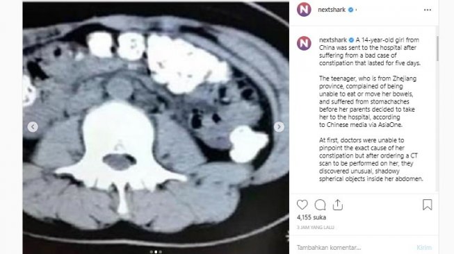 Hasil CT Scan si gadis (Instagram/Nextshark)