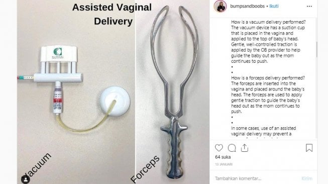 Forceps untuk melahirkan (Instagram/bumpandboobs)