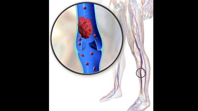 Deep Vein Thrombosis (e.wikiperdia.org)